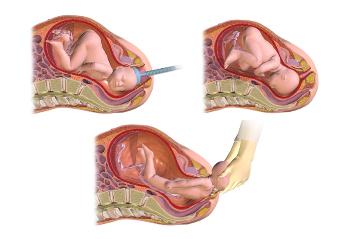 Mengenal Prosedur Vakum untuk Membantu Persalinan