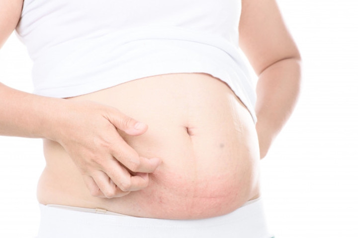 Serba-serbi Stretch Mark yang Perlu Anda Tahu