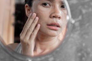 Melasma, Bercak Gelap di Wajah yang Sering Muncul saat Hamil