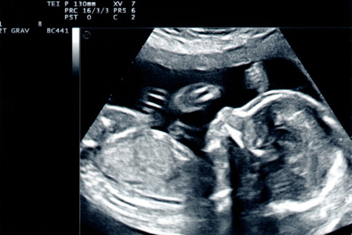 Mengenal Sindrom Turner, Kelainan Genetik pada Bayi