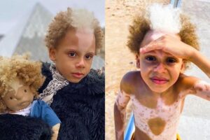 Viral! Supermodel Cilik dengan Kelainan Piebaldism