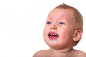 Rekomendasi Krim dan Losion untuk Atasi Biang Keringat pada Bayi