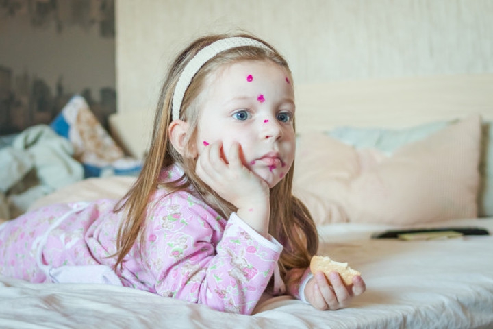 Makanan yang Harus Dihindari saat Anak Terkena Cacar Air