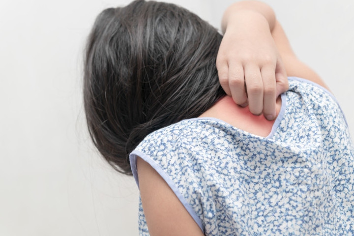 Herpes Zoster pada Anak, Serupa Tapi Tak Sama dengan Cacar Air