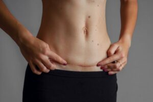 Cara Memijat Bekas Luka Operasi Caesar dan Manfaatnya