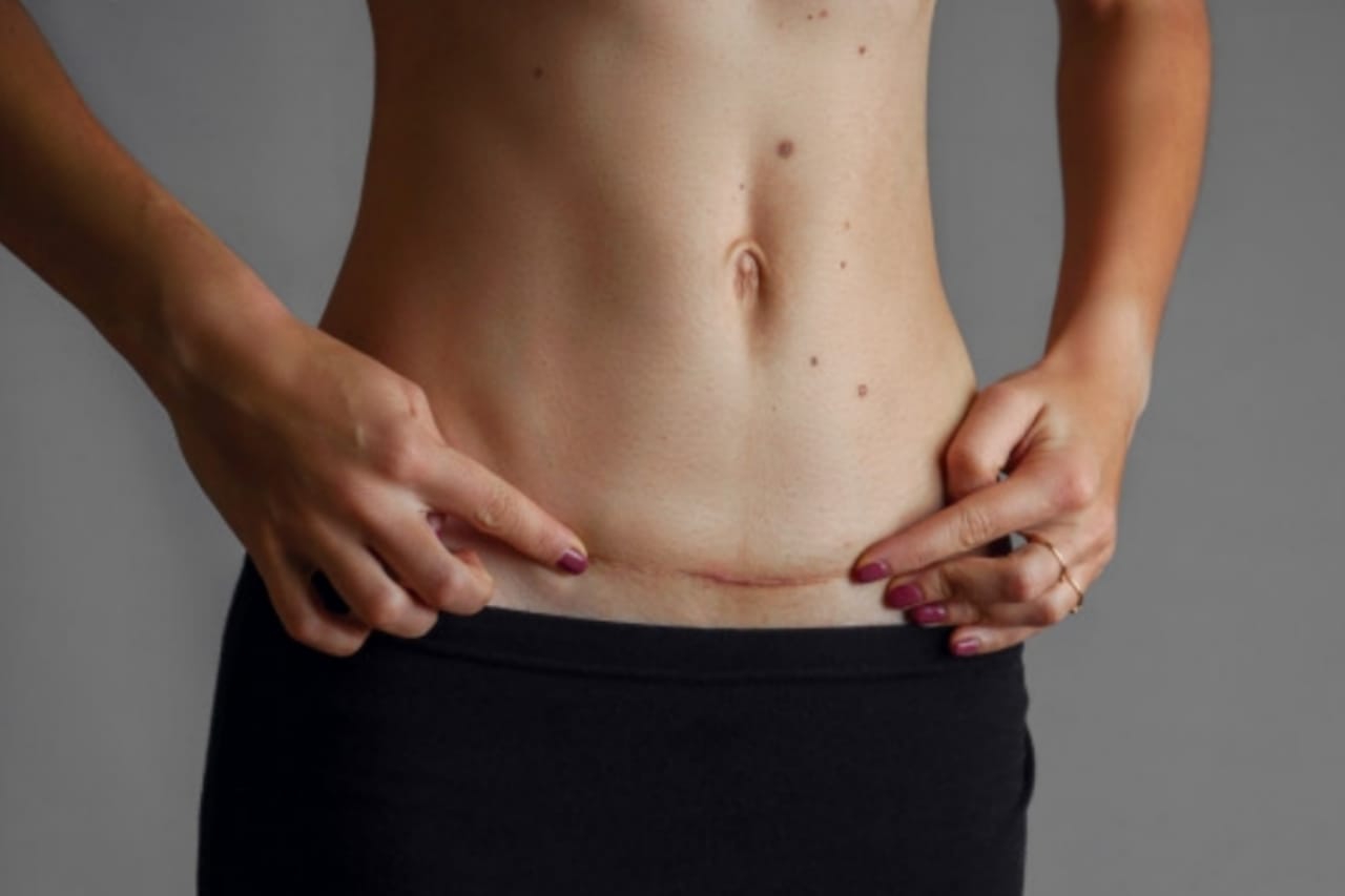 Cara Memijat Bekas Luka Operasi Caesar dan Manfaatnya