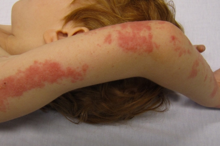 Mitos dan Fakta tentang Herpes Zoster yang Perlu Diketahui