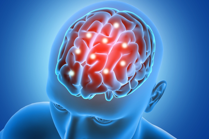 Mengenal Pendarahan Otak, Kondisi yang Dialami Tukul Arwana