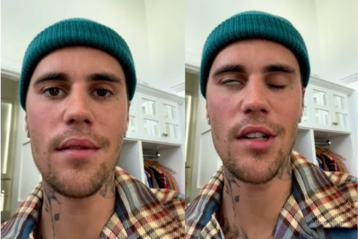 Kenali Ramsay Hunt Syndrome, Penyebab Wajah Justin Bieber Lumpuh