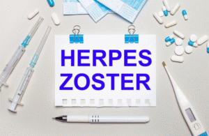 Menurut Dokter Kulit, Ini 7 Fakta Unik Seputar Cacar Ular atau Herpes Zoster