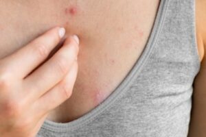 Penyebab Munculnya Jerawat di Payudara dan Cara Mengatasinya