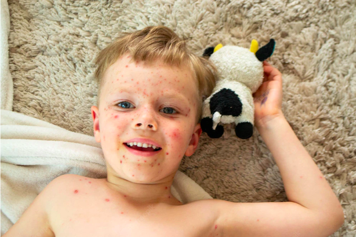 Awas, Kasus Campak Meningkat! Ketahui 7 Faktanya Berikut Ini