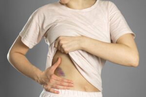 Muncul Memar Biru di Tubuh, Benarkah Karena Dijilat Setan?