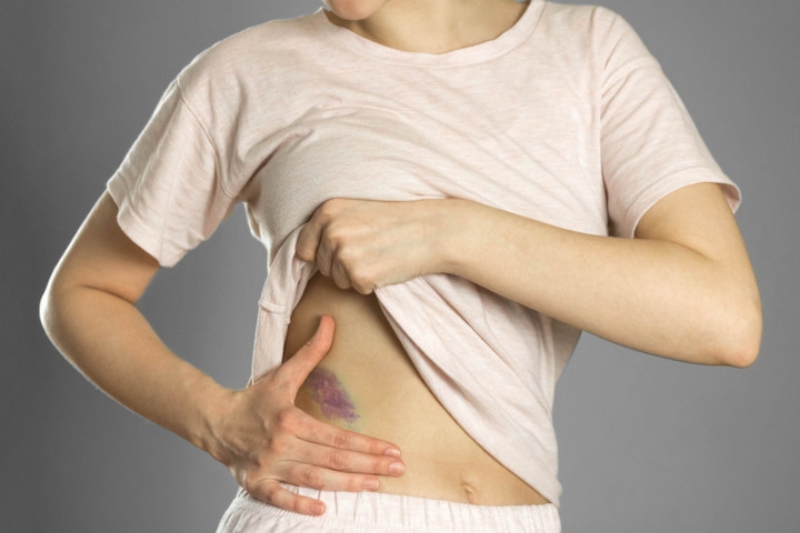 Muncul Memar Biru di Tubuh, Benarkah Karena Dijilat Setan?