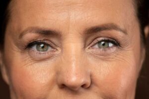 5 Tips Menghilangkan Kerutan di Bawah Mata