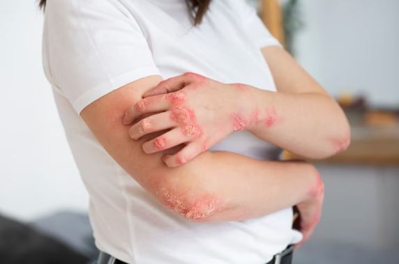 Tak Hanya Faktor Genetik, Stres Juga Bisa Menjadi Pemicu Psoriasis