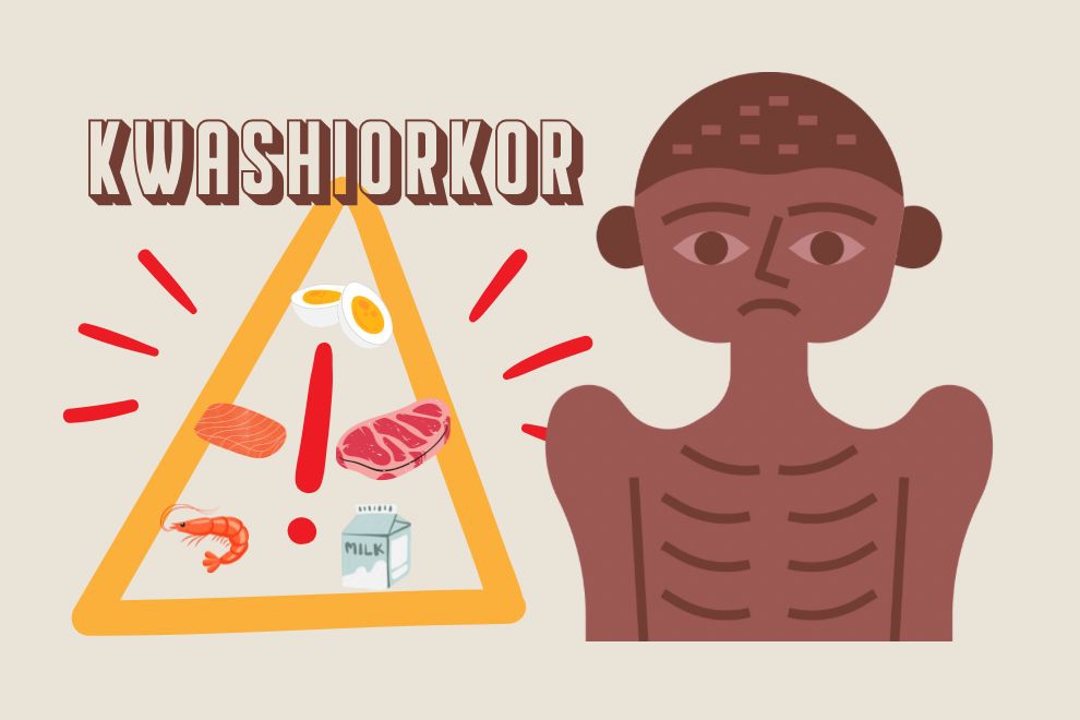 Kuku Anak Rapuh? Awas, Bisa Jadi Tanda Kwashiorkor, Lho!